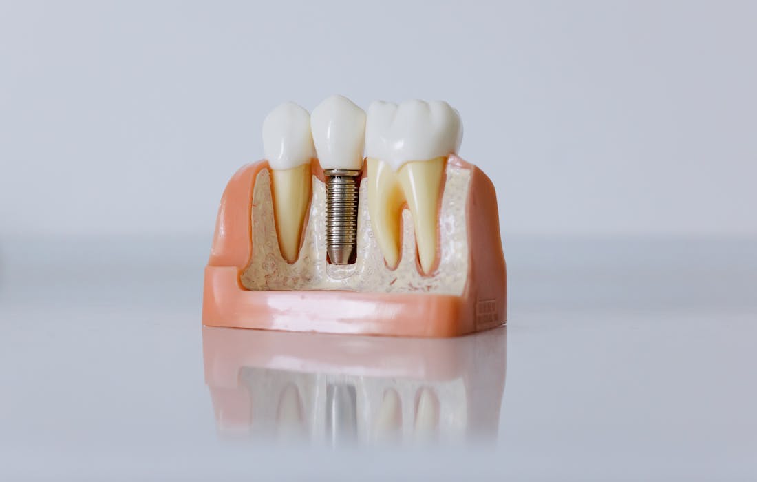 Guided Implant Surgery