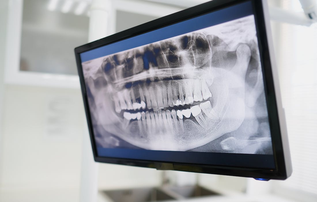 Digital X-Rays